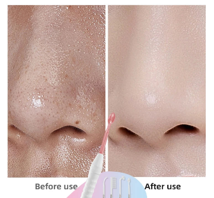 Radiance Pro High Frequency Electrotherapy Wand - Neon