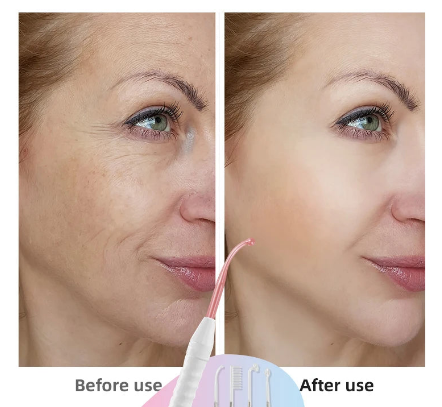 Radiance Pro High Frequency Electrotherapy Wand - Neon